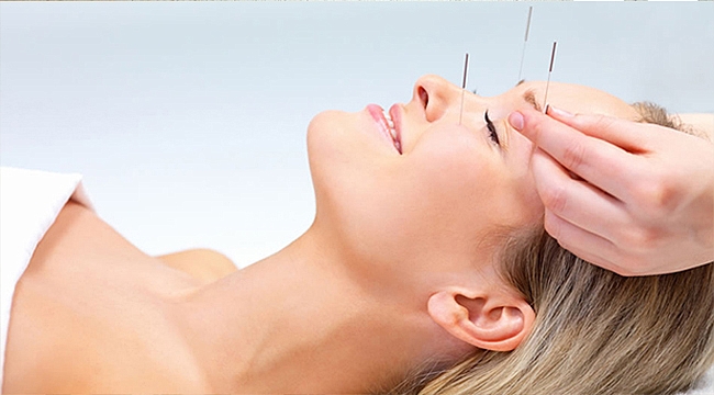 Akupunktur İle Migren Tedavisi Nasıl Yapılır?