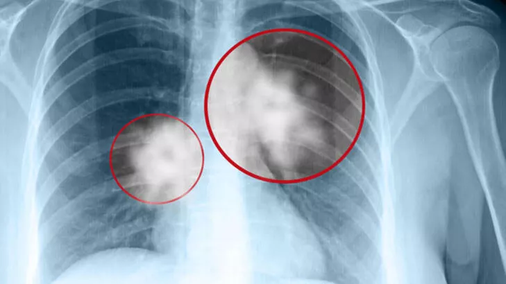 Akciğer kanseri nedir? Nasıl oluşur?