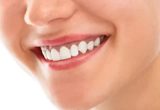 Diş Eti Morarması Nasıl Geçer Tedavi Yöntemleri Nelerdir?