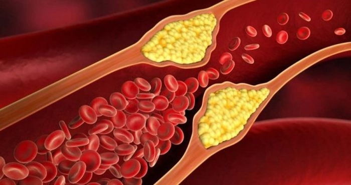 Kolesterol Nedir? Belirtileri Nelerdir Hangi Önlemler Alınmalı?