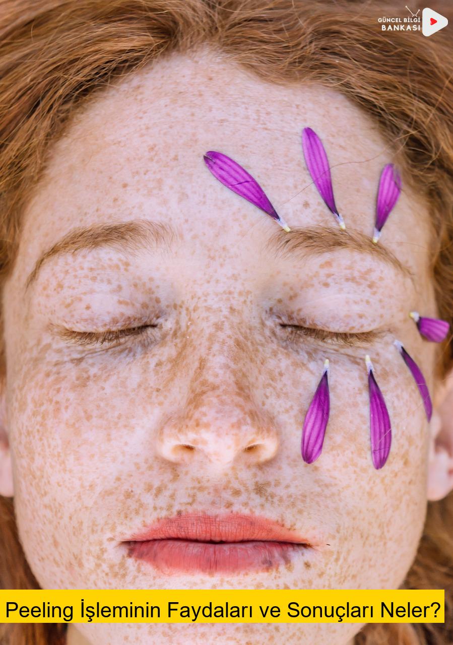 Peeling İşleminin Faydaları ve Sonuçları Neler?