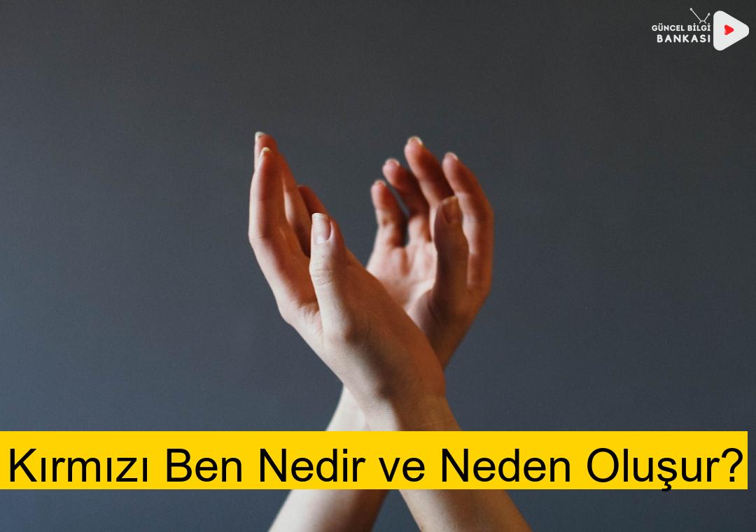 Kırmızı Ben Nedir ve Neden Oluşur?