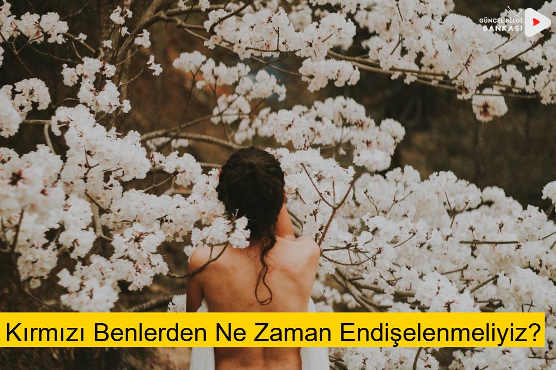 Kırmızı Benlerden Ne Zaman Endişelenmeliyiz?