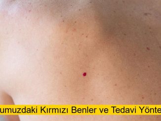 Vücudumuzdaki Kırmızı Benler ve Tedavi Yöntemleri (Güncel 2025) 1 Vücudumuzdaki Kırmızı Benler ve Tedavi Yöntemleri